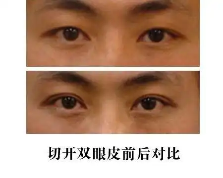 男生割双眼皮前后对比照片