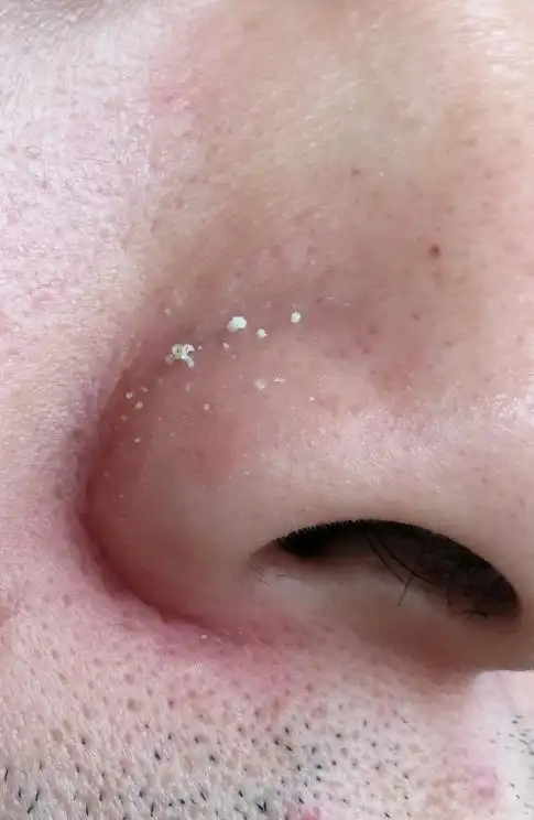 就会有白色脂一样的 被挤出来,不喜欢这感觉,毛孔也粗大,看图,怎么办