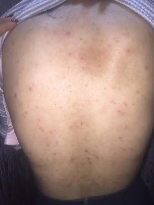 前胸后背长痘痘,这样的皮肤应该如何治疗?