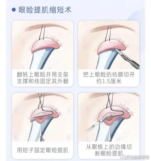 上睑下垂##整形