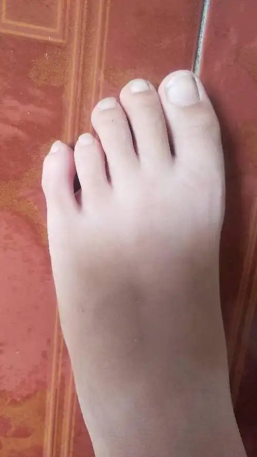 10岁女孩子长这样的脚趾头对她将来会不会有影响?