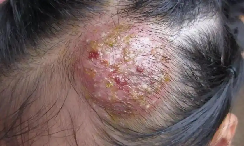 听说10后也要秃了4岁女孩头发几乎掉光原因竟是这样