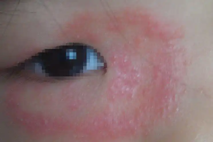 亚急性,慢性皮炎症状,主要表现为接触部位皮肤出现红肿,丘疹,丘疱疹