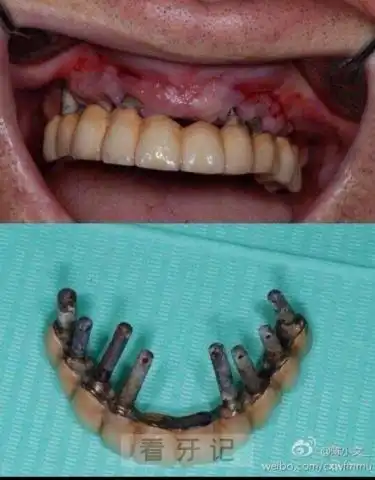 做种植牙的人都太傻了附全口种植牙失败案例图片