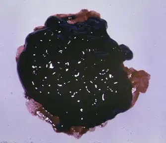 我这种情况是胃出血吗?