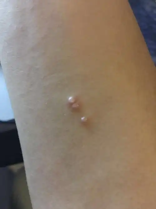 手臂上就长了3个小痘痘是怎么回事?是皮肤过敏吗?