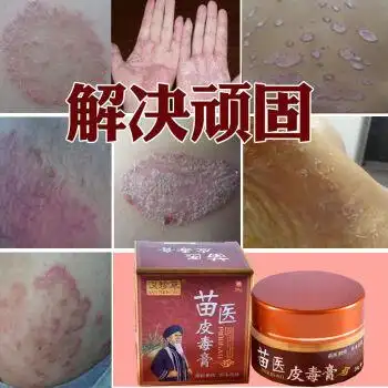 103癣消止痒特孝手脚大腿内侧私密处皮肤瘙痒顽固湿l疹全身止痒抑菌