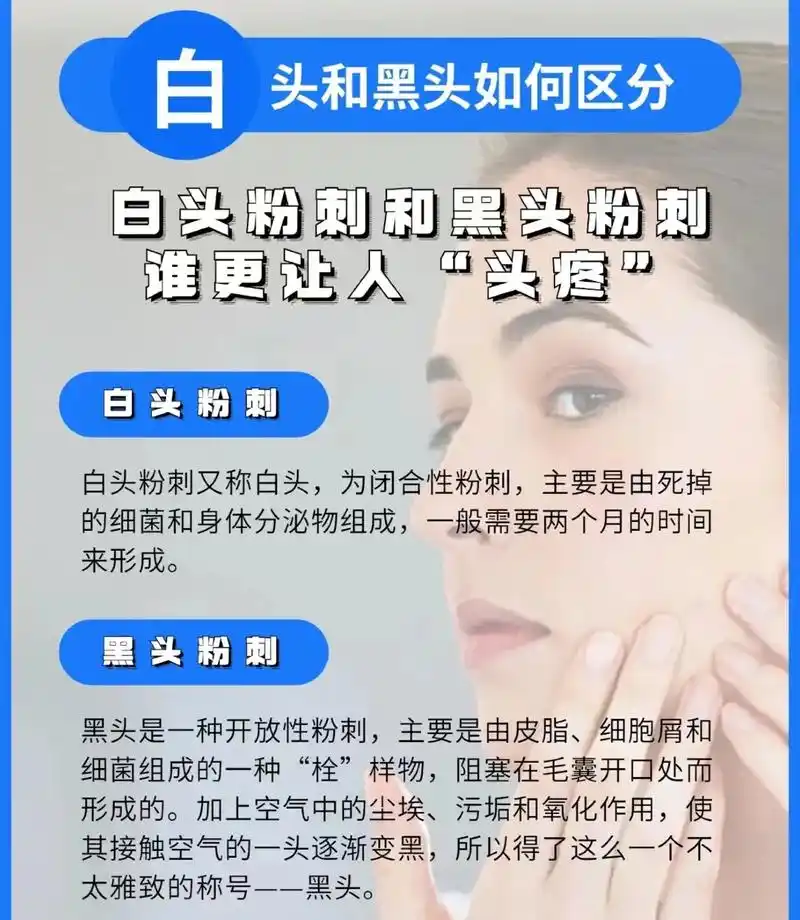 今日护肤分享 黑头,白头,粉刺怎么办?#护肤分享 #护肤常识 - 抖音