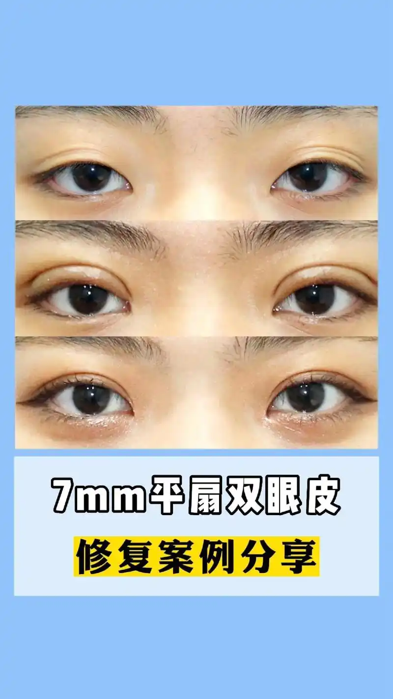 这位求美者之前做过埋线双眼皮,失 - 抖音