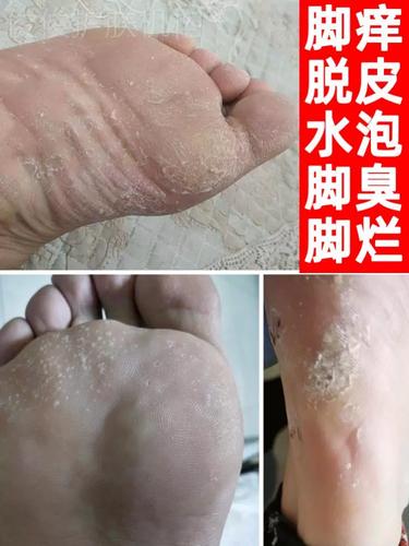 推荐水泡型脚臭气治脚痒脱皮烂脚丫去脚臭日本进口脚气水除脚臭气