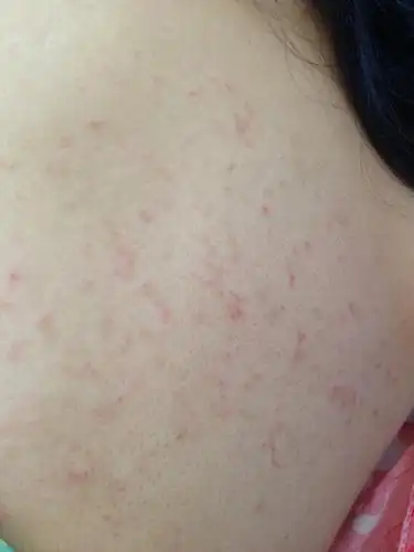 后背集中一片红疙瘩 有一段时间了 昨天突然很痒_百度知道