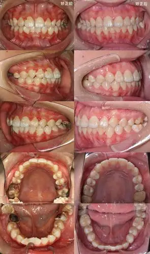 牙齿矫正同样有效!