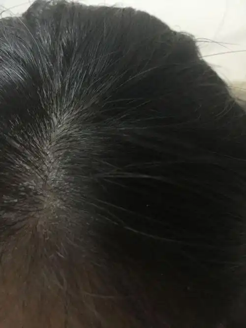 因为长久抠头,头皮都一块块的,刚洗完头吹完头就能看到白白的一片头皮