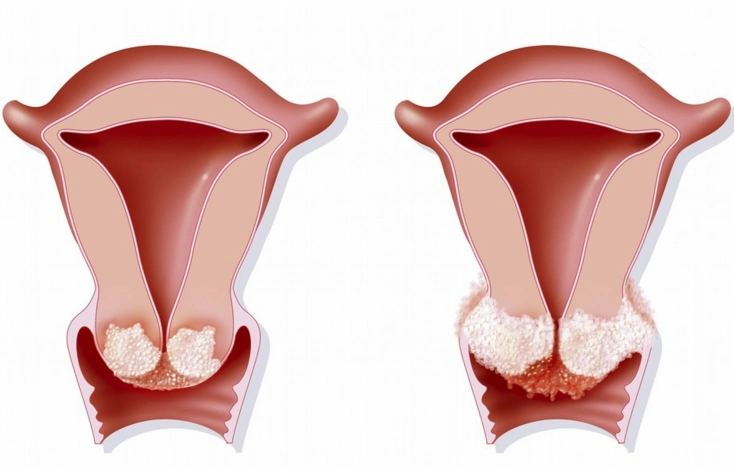 女性坚持做宫颈癌筛查,再学会驱除hpv,余生远离宫颈癌