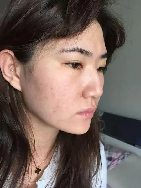 半个月前做了果酸换肤 当时脸上微微结痂 只有两处结的痂稍有严重 脱