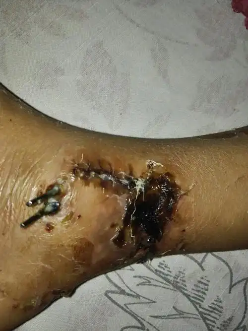 8岁小孩脚裸处受伤,伤口缝合24天后,发现有一部分坏死发黑.