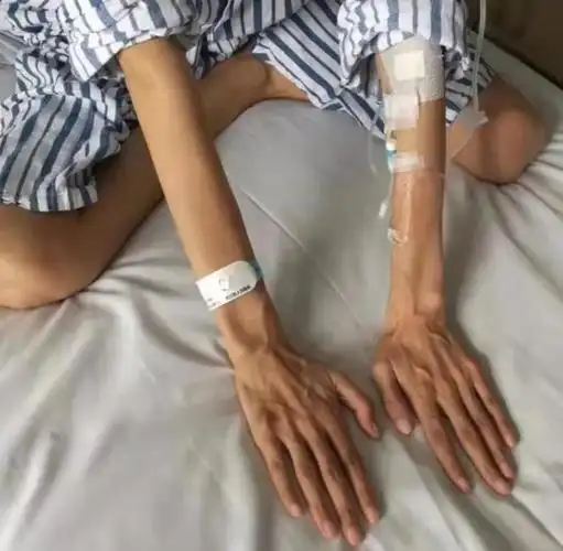 婧婧的手指,脚趾都很细长,这是马凡综合征病人最具代表性的蜘蛛指(趾