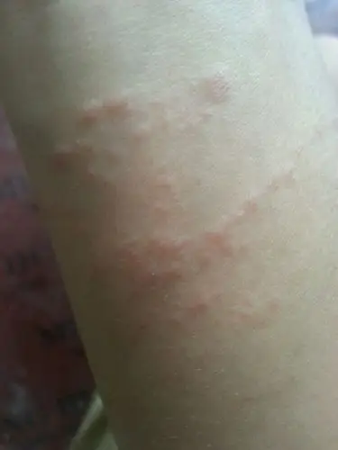 皮肤过敏来个大夫帮看一下什么原因