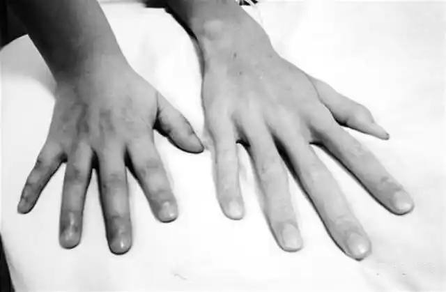 马凡氏综合征的相关致病基因:fbn1