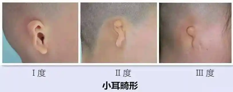 耳郭和耳廓的区别图片,耳郭和耳廓的区别