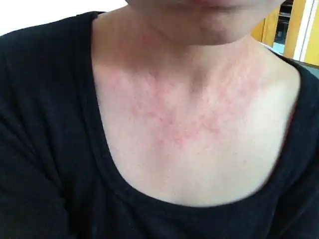 脖子一直痒 吃药都不管用 请问这是化妆品过敏 还是风疹?