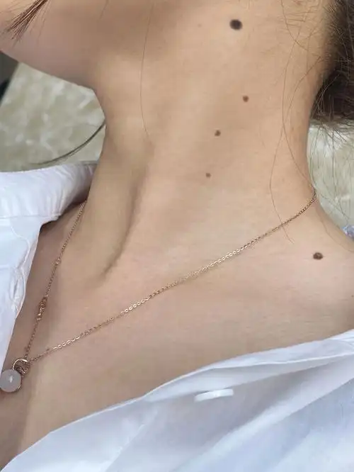 脖子点痣真是没有一天不后悔的