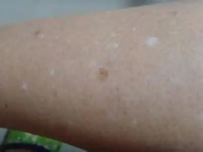 哪些习惯更利于白癜风的康复