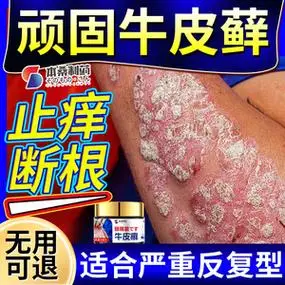 治牛皮癣药膏-淘宝拼多多热销治牛皮癣药膏货源拿货 - 阿里巴巴货源