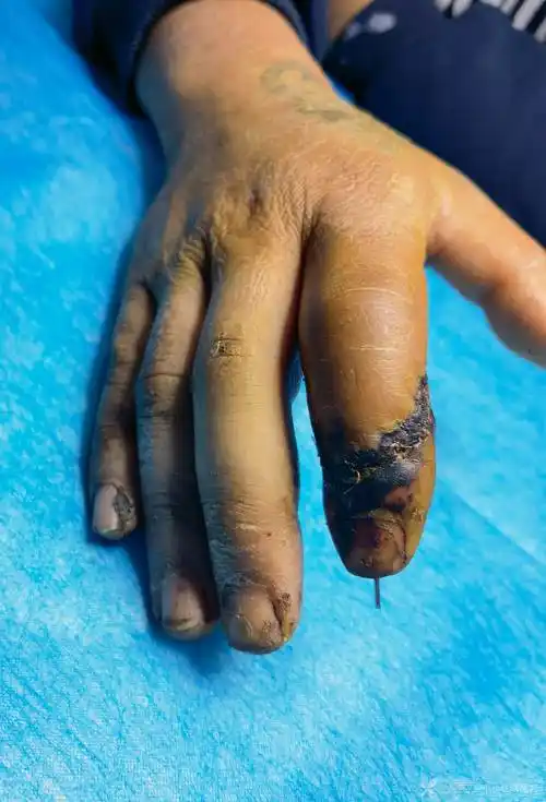 断指再植术后皮肤坏死怎么办