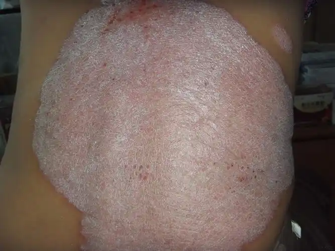 今天遇见大面积牛皮癣一例分享 - 皮肤及性传播疾病讨论版 - 爱爱医