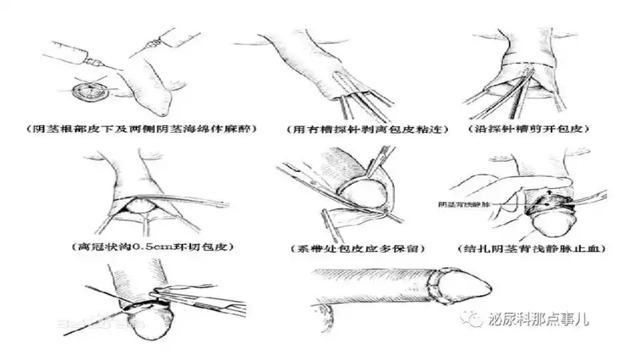 您关心的割包皮手术对比