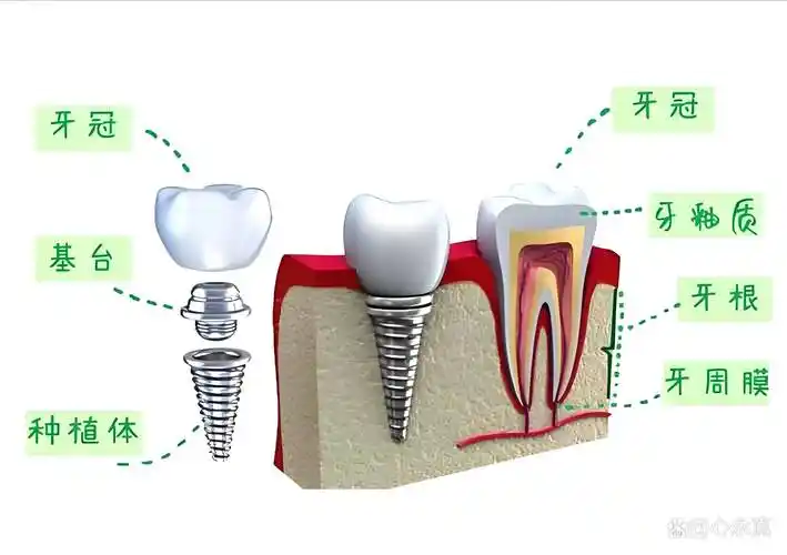 种植牙的咬合力与真牙的比较