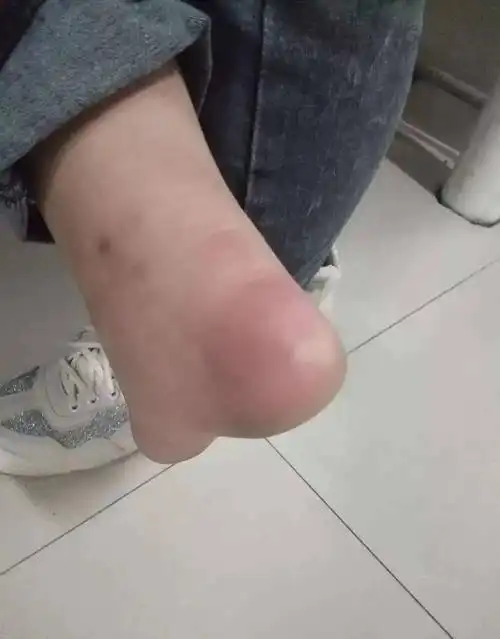 网友  姐最时尚 发帖:  只要开始下雪天,脚就起冻疮,今年可能真的会