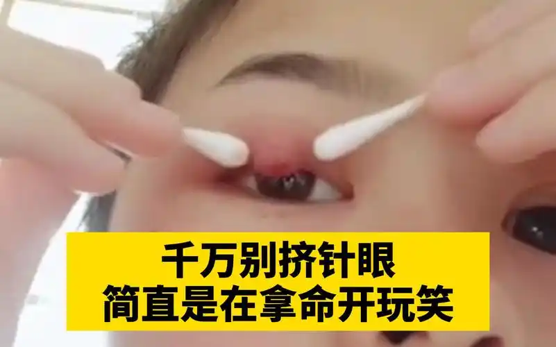 【科普】针眼不要挤,眼睛这个地方的静脉是没有静脉