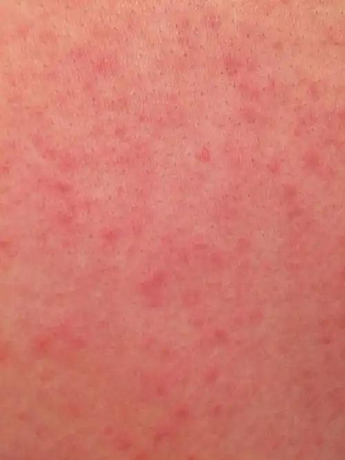 很痒,已经两天了,吃了抗过敏的药也还没好,以前我吃虾也不过敏