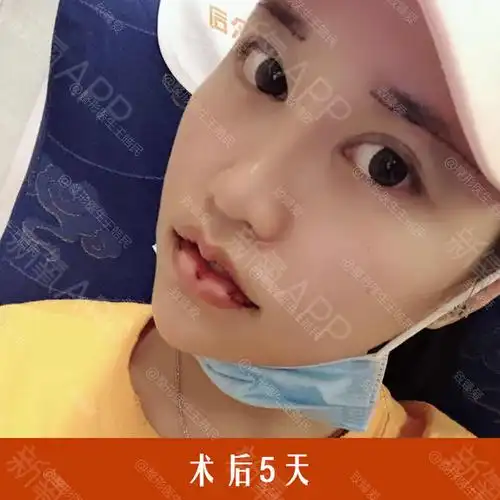 厚唇改薄好不好_效果图_致臻爱小白厚唇改薄术后第3天_新氧美容整形