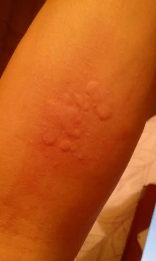 身上最近都这样起胞,很痒,这是手臂上的,身上的更大些,是什么症状?