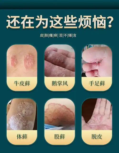 痒牛皮花斑银屑头皮毛囊痘痘外用百癣膏止痒膏选大夫冰蚕地球人2552