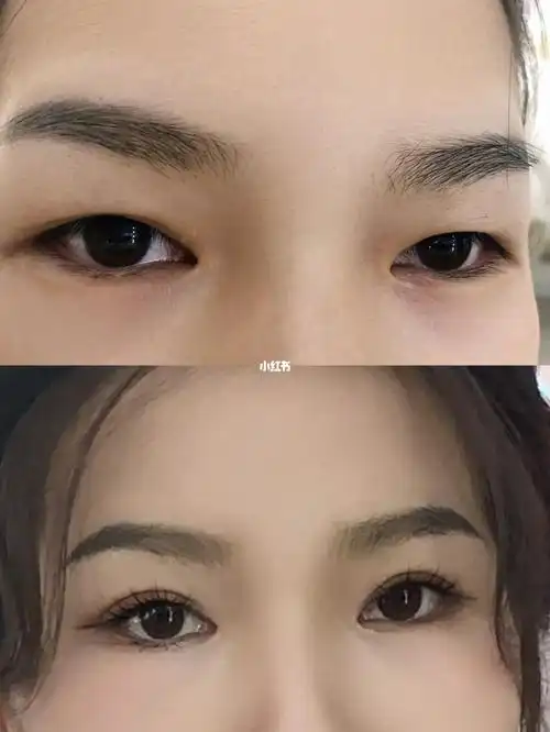单眼皮对比双眼皮