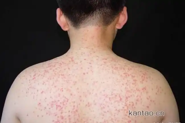 检查毛囊炎的发病原因,如果是因原有疾病导致的,应积极治疗引发毛囊炎