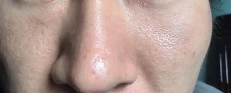 毛孔粗大不熬夜一个月 十九岁经常熬夜皮肤爱出油干燥毛孔大脸上皮肤