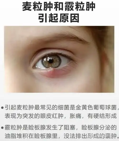 表现为眼睑皮下圆形肿块,一般无疼痛.