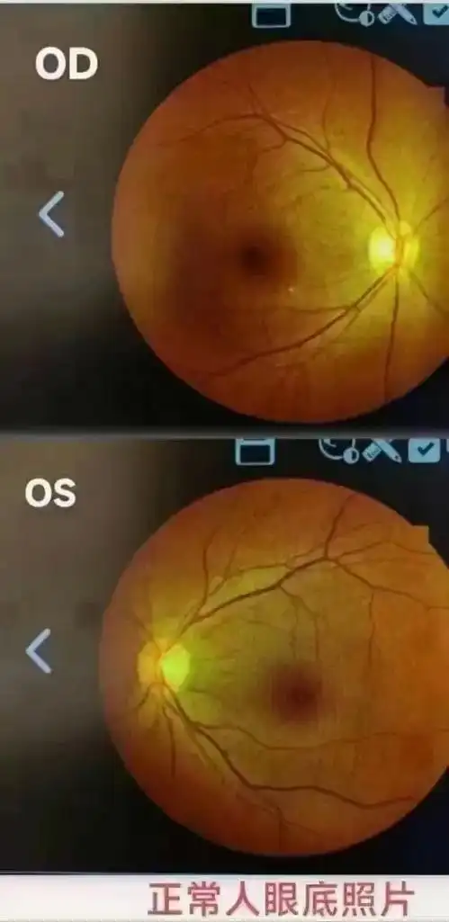 眼底照片:带你了解高度近视患者眼底和正常人眼底的状态,就知道 - 抖