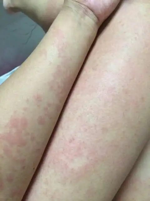 怀孕15周,身上突然起了一片一片的红疹,很痒,去医院检查只说过敏性