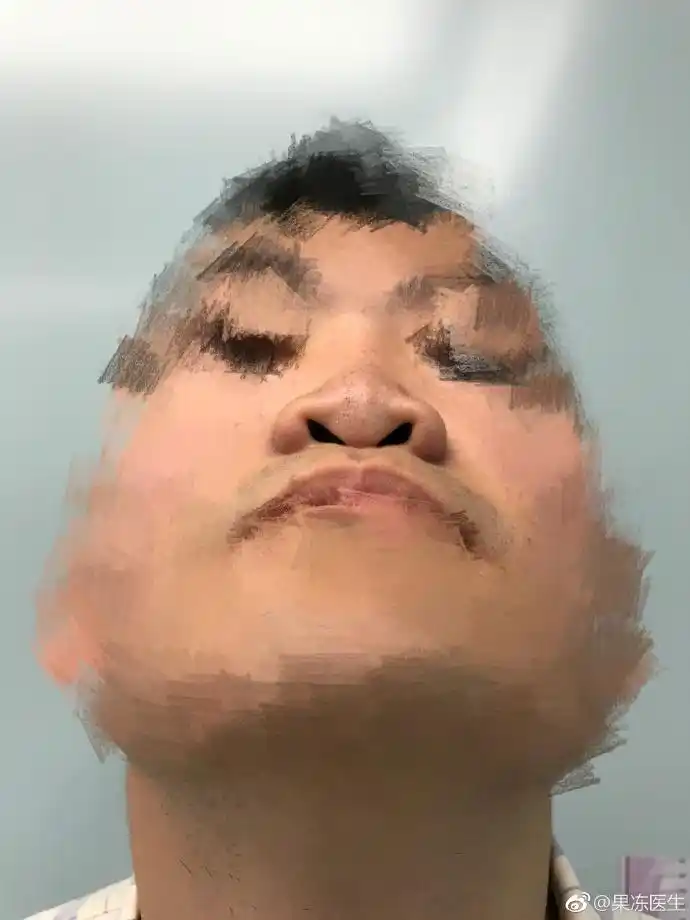 binder综合征是颅颌面外科的常见疾病,其发病机理目前还不是十分清楚.