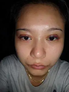 请问埋线双眼皮第三天淤青肿胀成这个样子 算正常吗》?