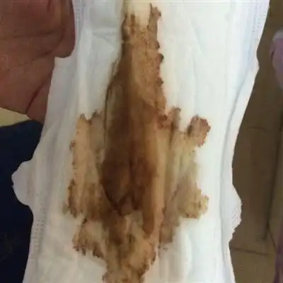 内裤上有褐色分泌物怎么回事