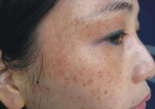 脸上肝斑图片54