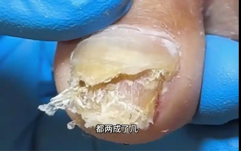 指甲里都长虫子了