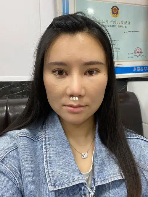 脂肪填充第十天,两边脸不对称_脂肪填充_相机_全国自体脂肪全脸填充